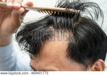 Bald In The Head And Begin No Loss Hair Glabrous Of Mature Asian Business Smart Active Office Man.