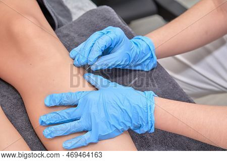 Close-up Of Shirtless Man Receiving Dry Needling Therapy From Physician In Clinic Close-up Of Physio