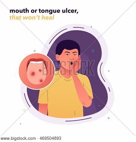 Vector Illustration Of A Man With Ulcers On His Tongue. Non-healing Wounds In The Oral Cavity. A Man