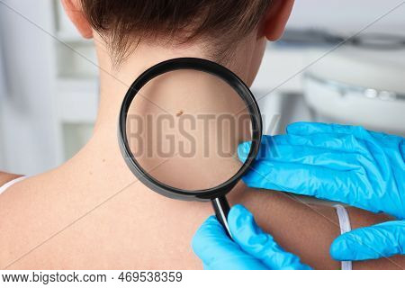 Dermatologist Examining Patient's Birthmark With Magnifying Glass In Clinic, Closeup