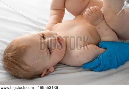 Doctor Checking Skin Of Sick Girl. Kid With Red Rash Being Examined At The Physician. Allergic Rash,