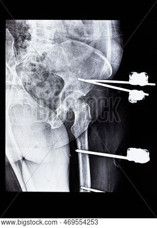 X-ray With External Fixation Device Fixed In Femur And Pelvic Bones