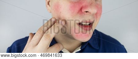 Rosacea Face. The Man Suffers From Redness On Her Cheeks. Couperose Of The Skin. Redness And Capilla