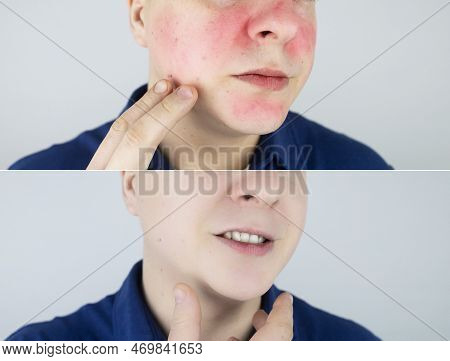Rosacea Face. The Man Suffers From Redness On Her Cheeks. Couperose Of The Skin. Redness And Capilla