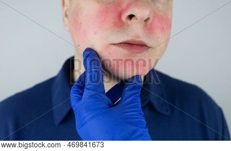 Rosacea Face. The Man Suffers From Redness On Her Cheeks. Couperose Of The Skin. Redness And Capilla