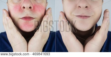 Rosacea Face. The Man Suffers From Redness On Her Cheeks. Couperose Of The Skin. Redness And Capilla