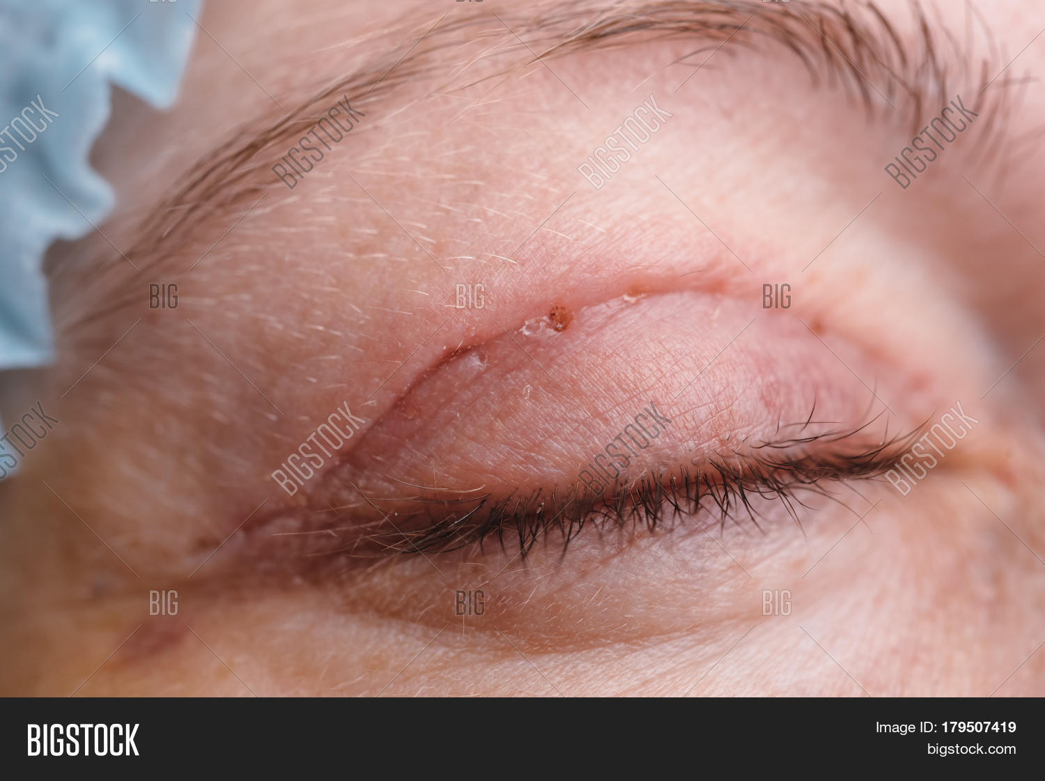 Blepharoplasty Upper Eyelid. Image & Photo Bigstock