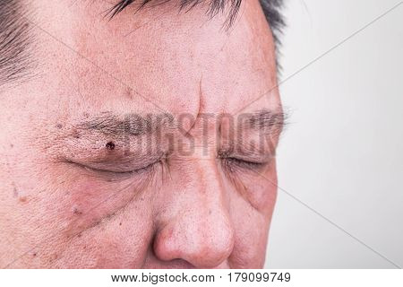 Mole Removed Via Skin Graft Procedure Leaving Scar