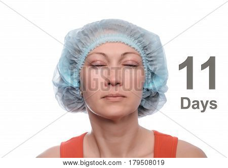 Blepharoplasty of the upper eyelid. An operation that removes the excess ugly skin of the eyelids above the eyes. The eyes are closed. Photos are taken at different times to track the healing process of the skin. Eighteen days after the operation.