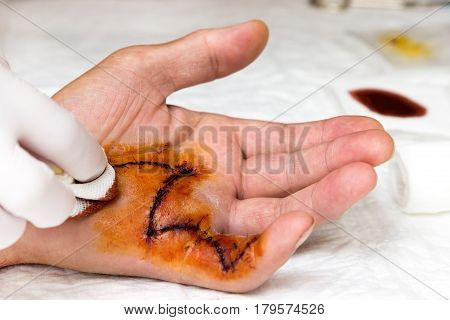 Wound is treated after a Dupuytrem operation