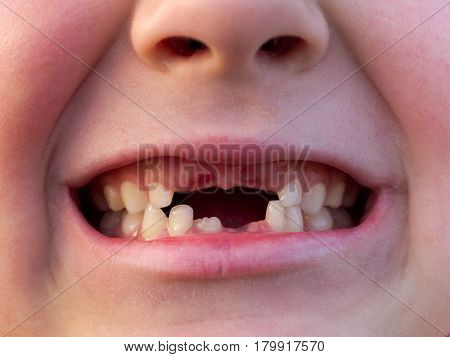 Mouth Of Boy With Changing Teeth