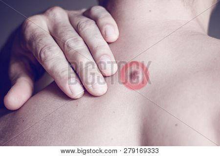 Fibroma On The Male Back, Details, Close-up