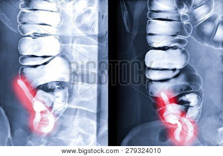 Barium Enema Image Or X-ray Image Of Large Intestine  Showing Anatomical Of Large Intestine And Appe
