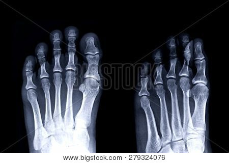 Gouty Arthritis . Film X-ray Of Left Toe Front And Oblique View.
