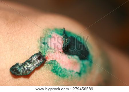 Healing Wound On The Knee. The Wound Treated With Brilliant Green. The Scab Will Climb