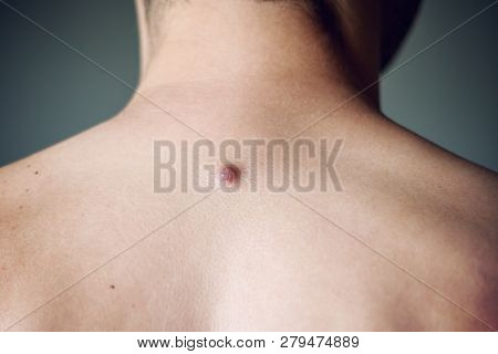 Fibroma On The Male Back, Details, Close-up