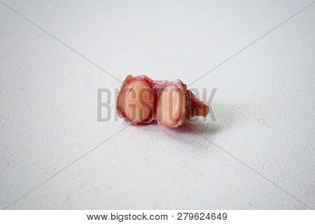 Fibroma, Mole Close-up In A Cut On A White Background