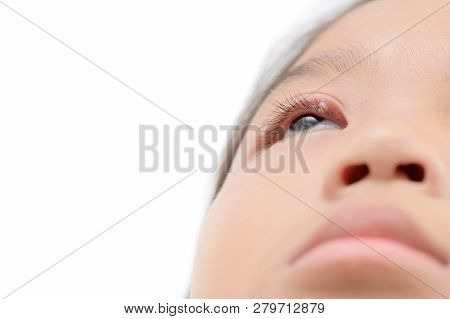 Close Up Of Asian Little Girl One Eye Infection Isolated