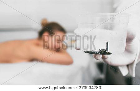 Patient During Leech Therapy, Alternative Hirudotherapy, Blood Purification