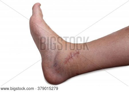 Scar On The Post-operative Ankle On White Background