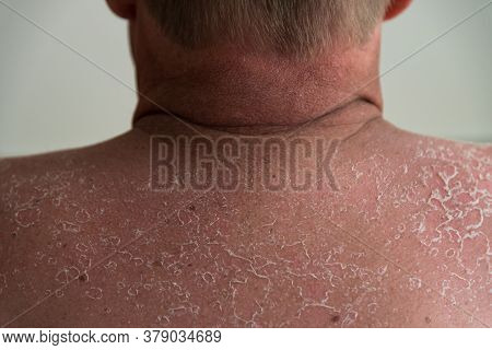 Sniffing The Blisters After Sunburn On The Back