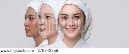Treatment Hyperpigmentation And Melasma On Face By Serum Mask, Before - After Facial Face Mask Of Be
