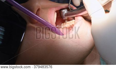 Drilling teeth and sucking saliva with ejector. Young woman at dental clinic. Female dentist with assistant treating cavities in a patient mouth in modern dental office.
