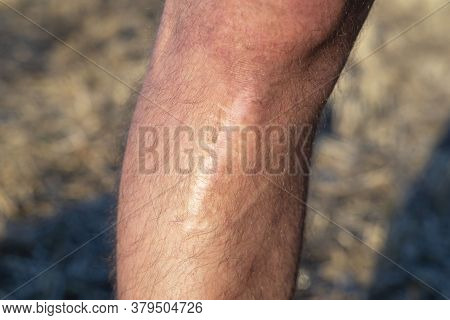 Scar On The Leg, After Injury. The Last Stage Of Wound Healing, Scarring. Skin Trauma, Wound Change 