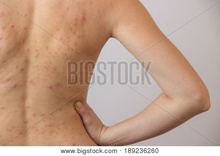 Young girl with acne with red spots on the back