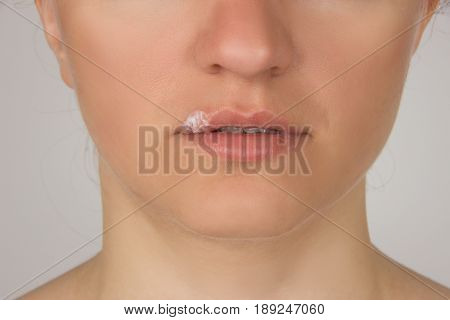 Herpes sore with pus on the lips of the young beautiful girl and a white cream on her finger