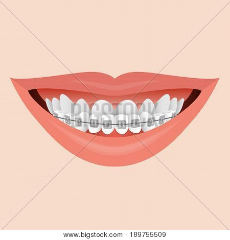 Closeup Human Lips Smile with Metal Braces.