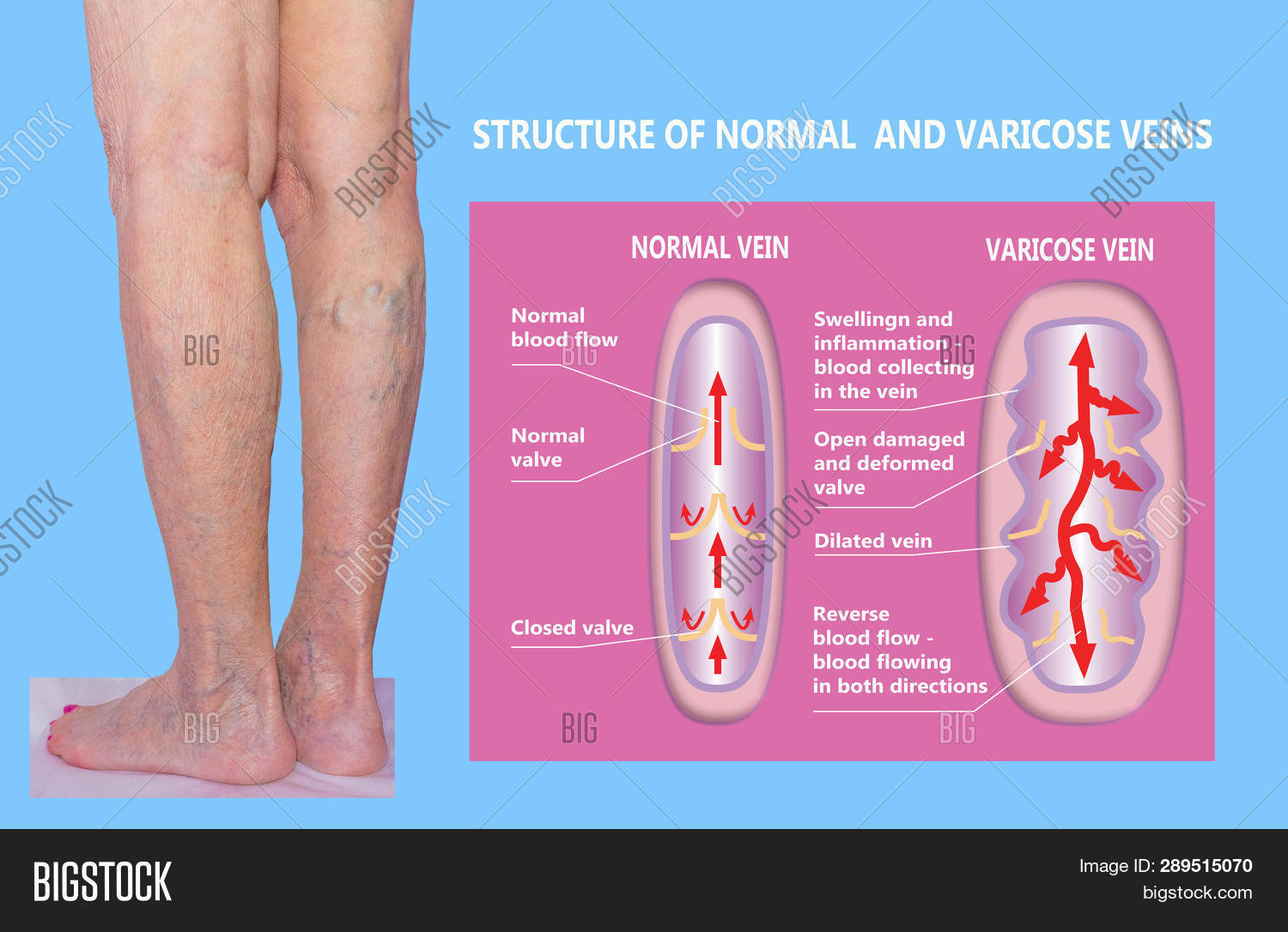 Varicose Veins On Image & Photo (Free Trial) Bigstock