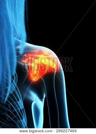 3d rendered medically accurate illustration of inflamed ligaments