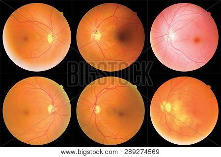 Collection Of Retinal Image  Of The Patient Taken With Retinal Photography Machine.