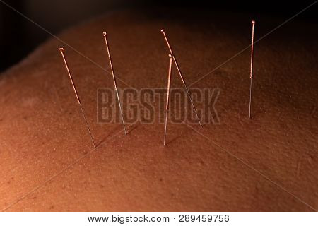 Several Acupuncture Needles To Make Treatment. Traditional Chinese Medicine Made With The Insertion 