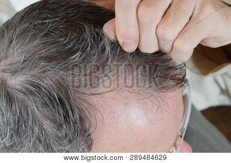 Trichotillomania, Human Impulse Behavioral Problem,hair Pulling Disorder