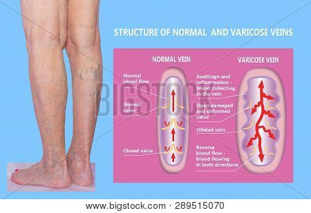 Varicose Veins On A Female Senior Legs. The Structure Of Normal And Varicose Veins. Concept Of Dry S
