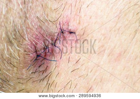 Caucaian Skin With Five Stitches. Macro View On Skin