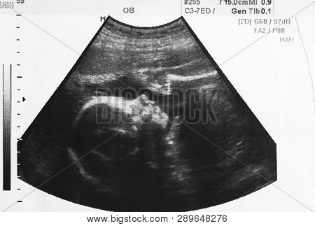 Ultrasound Photo Of Unborn Baby In Mother's Womb, Closeup View