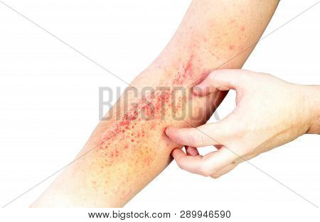 Atopic Dermatitis (ad), Also Known As Atopic Eczema, Is A Type Of Inflammation Of The Skin (dermatit