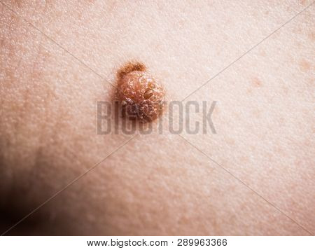 Unrecognizable Person Having Dark Fibroma, Dermatology Problem On Skin. Close Up Of Papilloma Dermat