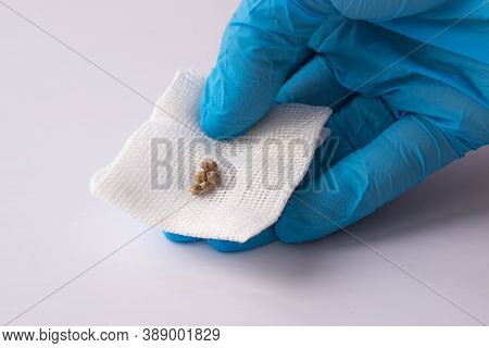 The Doctors Hand In A Blue Glove Holds The Cut Out Kami From The Gallbladder.