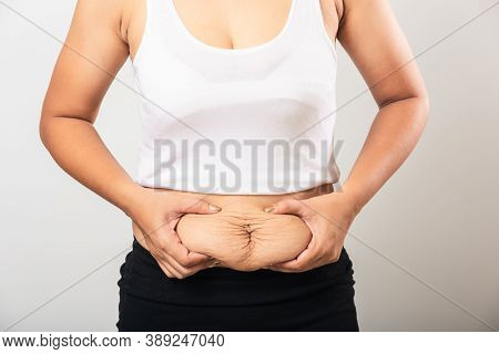 Close Up Of Asian Mother Woman Showing Stretch Mark Loose Lower Abdomen Skin She Fat After Pregnancy