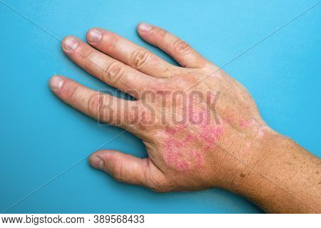 Burns Of Hand, Wounds. Hand With Sunburn. Type Of Burn.
