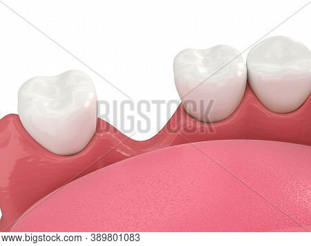 3d Render Of Jaw Bone Recession After Loosing Tooth Over White