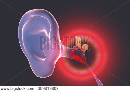 Otitis Media, A Group Of Inflammatory Diseases Of The Middle Ear, 3d Illustration