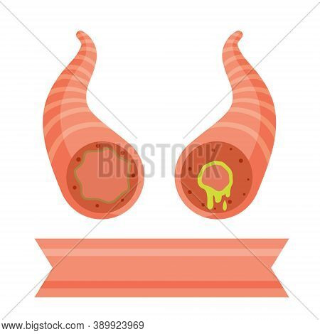 Asthma. The Medical Scheme. Cause Of Shortness Of Breath And Cough. Healthy And Sick Canal With Mucu