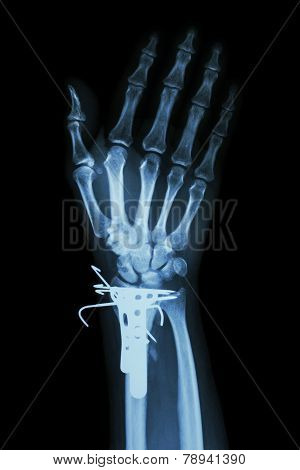 Fracture Distal Radius (forearm's Bone). It Was Operated And Ins