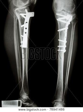Fracture Tibia(leg Bone). It Was Operated And Internal Fixed By Plate&screw