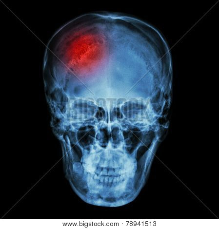 X-ray asian skull (Thai people) and headache and stroke